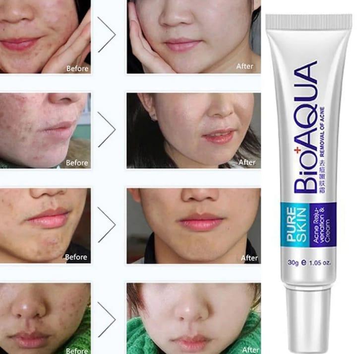 Acne Scar Removal Rejuvenation Cream ebazarmart